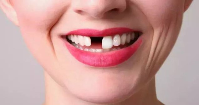 Rüyada Diş Dökülmesi Görmek Ne Anlama Geliyor?